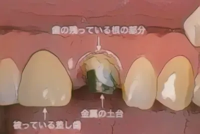 コント中に差し歯抜けた時の表情